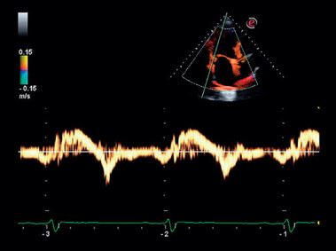 Imagen clínica - MyLab<sup>™</sup>Six - Imagen Doppler de tejido cardiaco (imagen TVM)