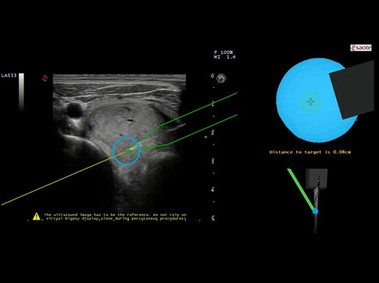 Clinical Image - MyLab<sup>™</sup>Twice - Virtually-guided Biopsy