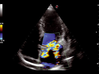 Imagen clínica - MyLab<sup>™</sup>Seven - Cuatro cavidades del corazón (imágenes XView y CFM)