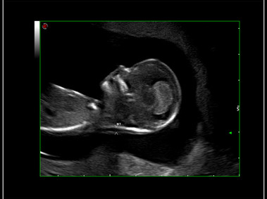 Clinical Image - MyLab<sup>™</sup>9 Platform - HD Zoom on fetus profile with AutoNT measurement