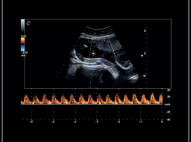 MyLab<sup>™</sup>Sigma - Clinical Image: Umbelical cord PW Doppler mode