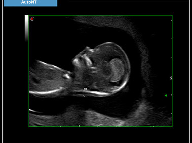 Clinical Image - MyLab<sup>™</sup>X7: AutoNT