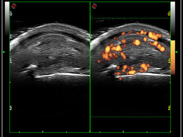 Clinical Image - MyLab<sup>™</sup>9 Platform - Very-superficial linear imaging with Power Doppler algorithm