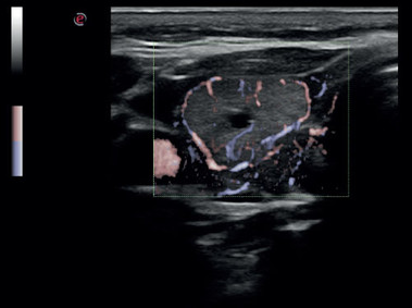 Imagen clínica - MyLab<sup>™</sup>Six - Vascularización tiroidea (imagen XFlow)