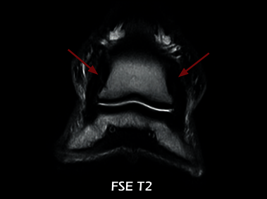Immagine clinica - O-scan equine: Lesione dei legamenti collaterali dell'articolazione interfalangea distale