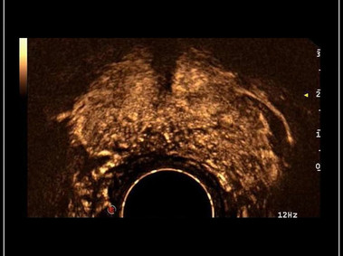 Clinical Image - MyLab<sup>™</sup>9 Platform - Prostate contrast enhanced imaging (CnTI<sup>™</sup>)