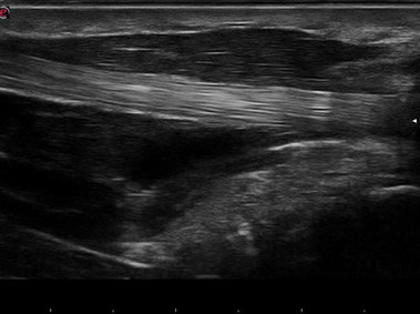 Clinical Image - MyLab<sup>™</sup>Gamma - Finger