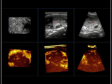 Clinical Image - MyLab<sup>™</sup>9 Platform - Pre-Post volumetric CEUS-multidataset comparison