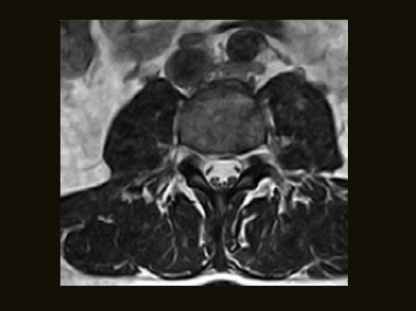 S-scan - L-spine 3D HYCE Axial