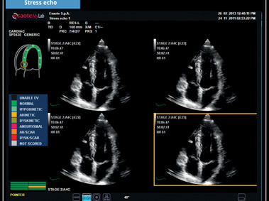 Clinical Image - MyLab<sup>™</sup>X7: Stress echo