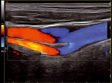 Клиническое изображение – MyLab<sup>™</sup>Twice – сонная артерия
