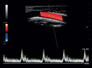 Imagen clínica - MyLab<sup>™</sup>Gamma - Arteria carótida (imagen B+CFM+PW)