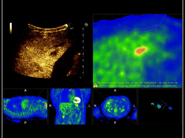 Clinical Image - MyLab<sup>™</sup>9 Platform - Real-time CEUS and PET fusion for lesion detection