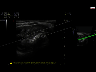 Clinical Image - MyLab<sup>™</sup>Eight eXP - Thyroid Virtual Biopsy