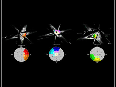 Clinical Image - MyLab<sup>™</sup>9 Platform - XStrain4D technology for volumetric heart assessment by coronary territories