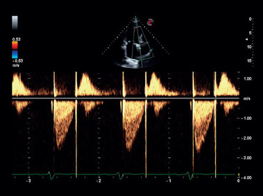 Klinisches Bild – MyLab<sup>™</sup>Gamma – Herz-CW-Spektral-Doppler