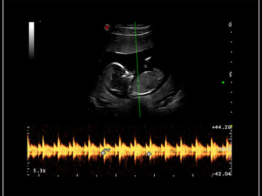 Clinical Image - MyLab<sup>™</sup>9 Platform - easyTrace to maximize Doppler performance