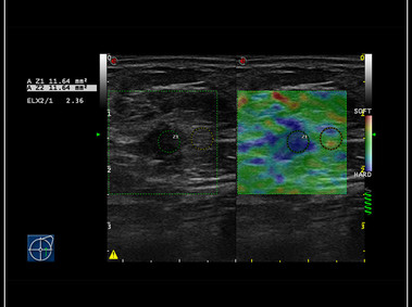 Clinical Image - MyLab<sup>™</sup>9 Platform - Elastography advanced measurement package on breast lesion