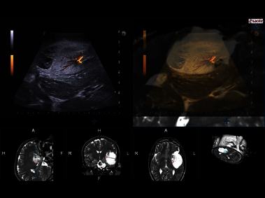 Clinical Image - MyLab<sup>™</sup>Eight eXP - Neurosurgery optimized Virtual Navigator