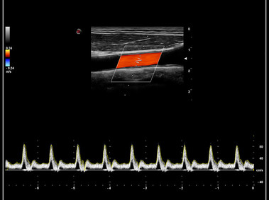 Clinical Image - MyLab<sup>™</sup>9 Platform - PW Doppler with easyTrace optimization