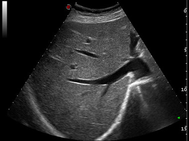Clinical Image - MyLab<sup>™</sup>Alpha - HD Abdominal Imaging