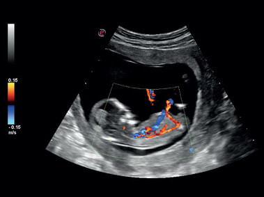 Clinical Image - MyLab<sup>™</sup>Six - Fetus (B+CFM Imaging)