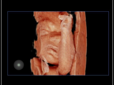 Clinical Image - MyLab<sup>™</sup>9 Platform - Baby Face rendering in real-time with XLight