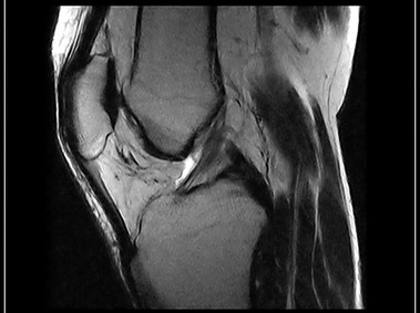 O-scan - Knee - FSE T2 Sagittal