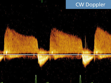 Clinical Image - MyLab<sup>™</sup>Seven - CW Doppler