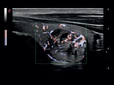 Clinical Image - MyLab<sup>™</sup>Gamma - Thyroid Vascularization (XFlow Imaging)