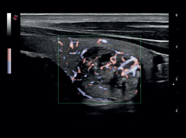 Klinisches Bild – MyLab<sup>™</sup>Gamma – Vaskularisation der Schilddrüse (XFlow-Bildgebung)