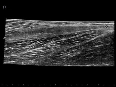 Clinical Image - MyLab<sup>™</sup>Gamma - Aquilles tendon (VPan Imaging)