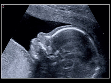 Clinical Image - MyLab<sup>™</sup>X8 Platform - Baby profile - XView algorithm for increased visibility