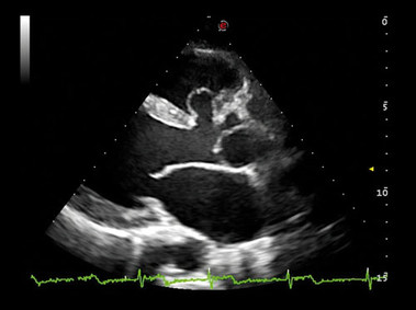 Клиническое изображение – MyLab<sup>™</sup>Alpha – сердце (технологии XView и TEI<sup>™</sup>)