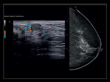 Clinical Image - MyLab<sup>™</sup>X8 Platform - Breast - Accurate multimodality diagnosis with Follow Up and BodyMap