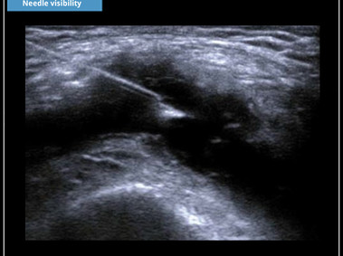 Clinical Image - MyLab<sup>™</sup>X7: Needle visibility