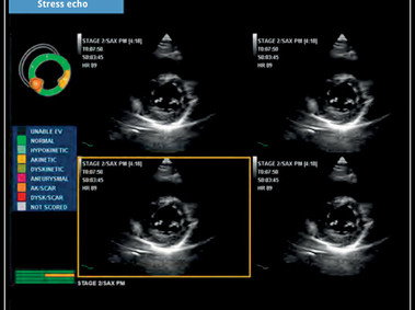 Clinical Image - MyLab<sup>™</sup>X5: Stress echo