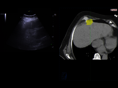 Clinical Image - MyLab<sup>™</sup>Eight eXP - Zero-degrees biopsy with Fusion Imaging