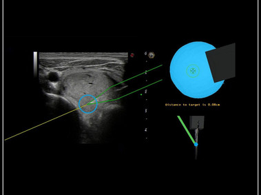 Clinical Image - MyLab<sup>™</sup>9 Platform - Precise lesion detection and guidance with Virtual Biopsy