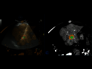 Clinical Image - MyLab<sup>™</sup>Eight eXP - Microwave ablation in liver HCC