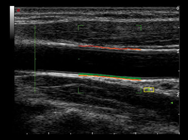 Клиническое изображение – MyLab<sup>™</sup>Alpha – сонная артерия (технология RFQIMT)