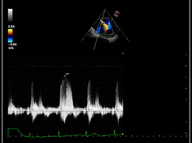 Clinical Image - MyLab<sup>™</sup>Omega - CW Doppler