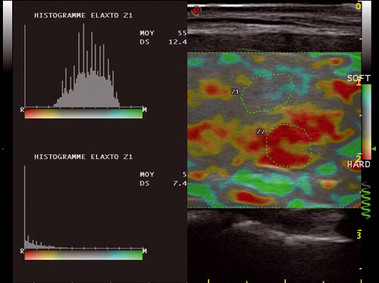 Клиническое изображение – MyLab<sup>™</sup>Twice – исследования груди (технология Elaxto)