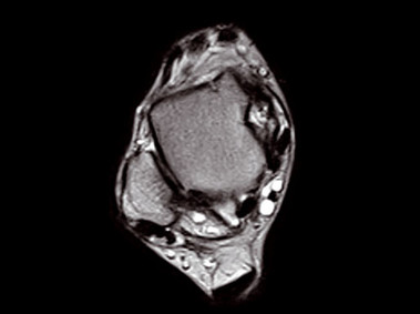 O-scan – Лодыжка, быстрое спин-эхо, осевая проекция T2