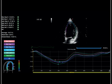 MyLab<sup>™</sup>Sigma - Clinical Image: Left Ventricle XStrain 2D analysis