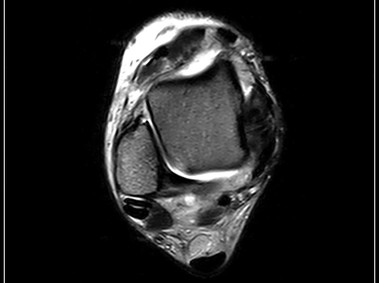 O-scan - Ankle - FSE T2 Axial