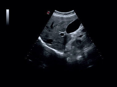 Clinical Image - MyLab<sup>™</sup>Six - Liver (XView - MView Imaging)