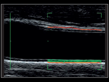 Clinical Image - MyLab<sup>™</sup>X8 Platform - Carotid - Real-time measurement of the Intima Media with QIMT