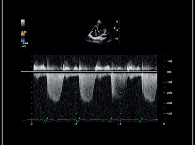 MyLab<sup>™</sup>Sigma - Clinical Image: CW Doppler of Tricuspid regurgitation