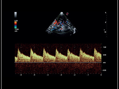 MyLab<sup>™</sup>Sigma - Clinical Image: Mid cerebral artery investigation with PW Doppler mode